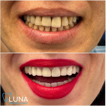 Slider image (9) Luna Dental Clinic